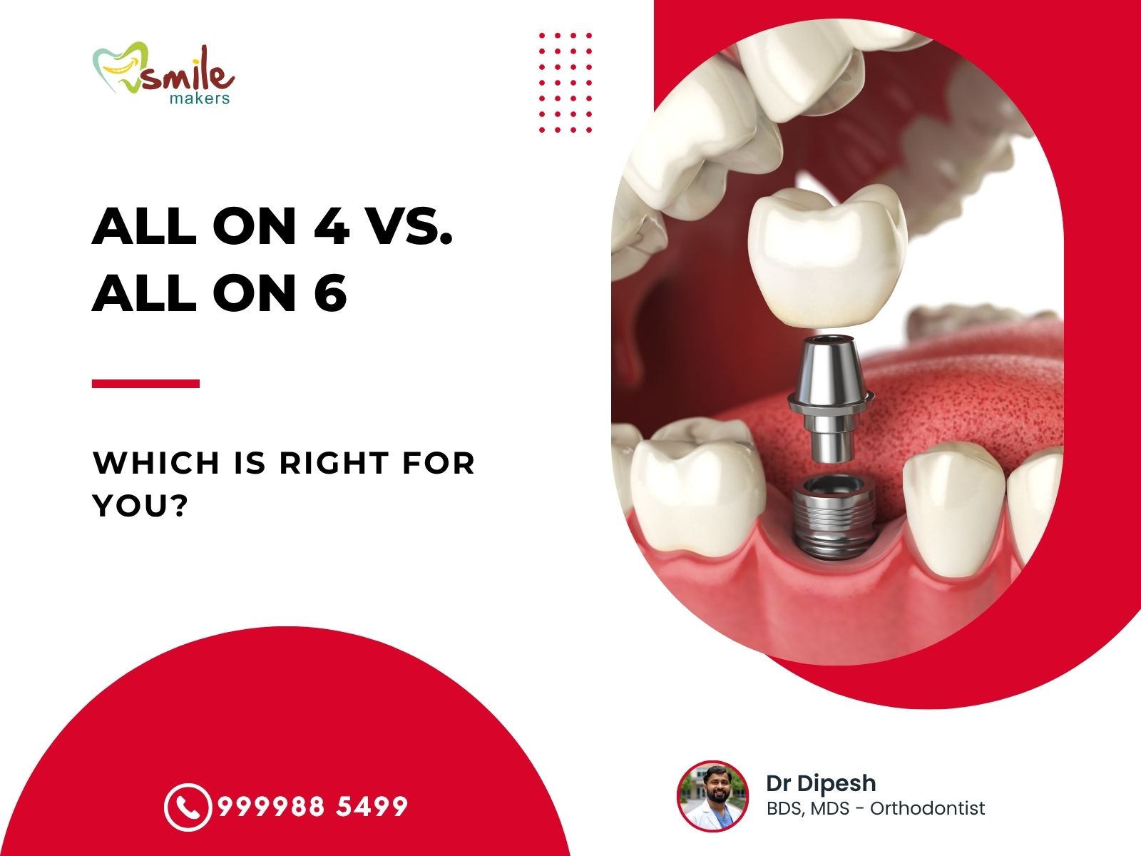 All on 4 vs. All on 6: Which Dental Implant Solution is Right for You?